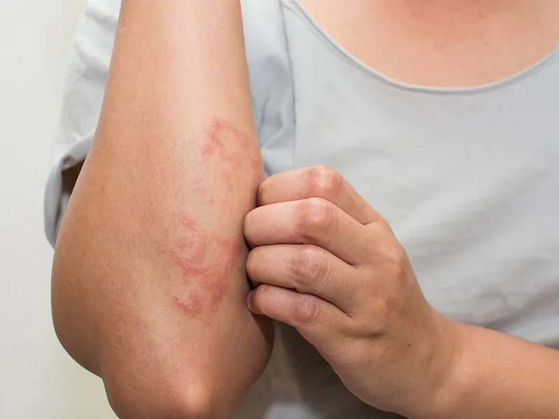 Bị dị ứng lông chó mèo phải làm sao? Nguyên nhân và triệu chứng